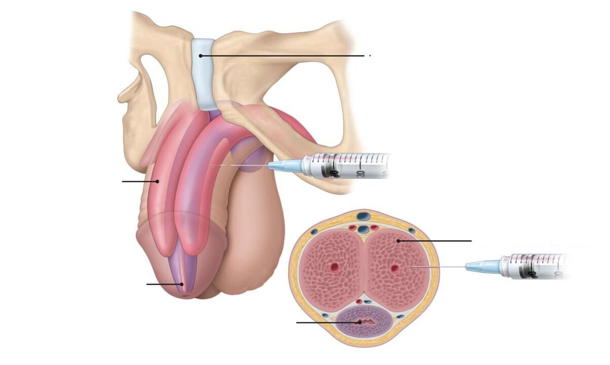 inyecciones para aumentar la potencia